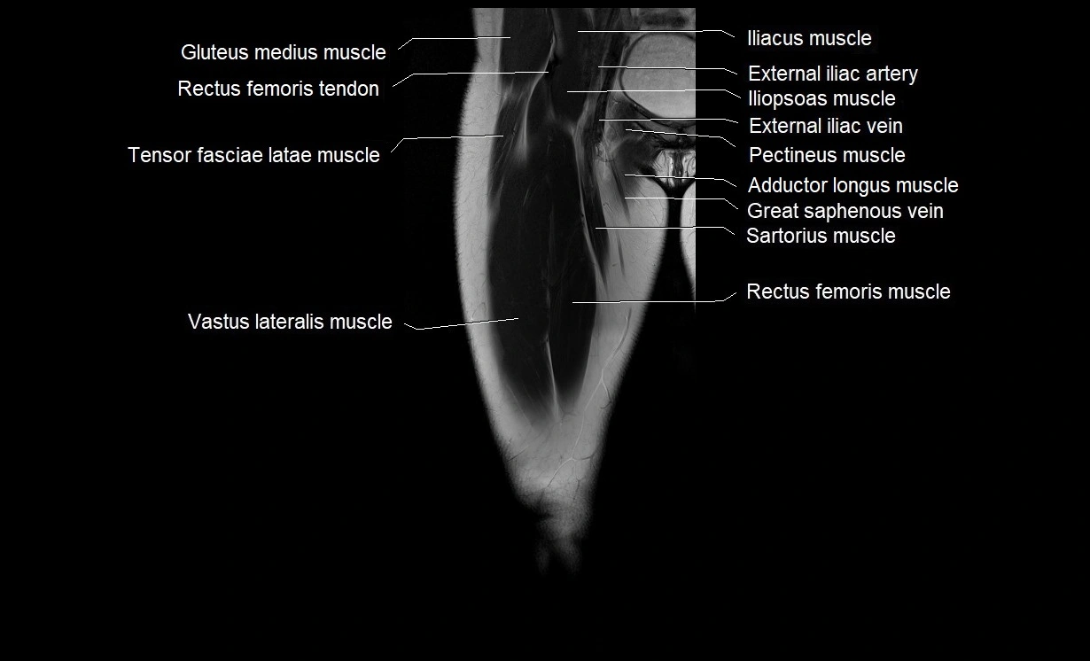 MRI thigh coronal cross sectional anatomy image 5.webp